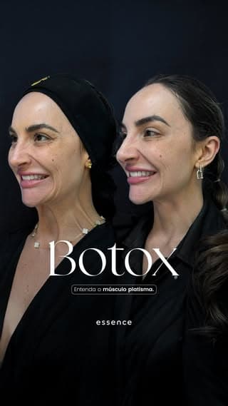 Botox para um contorno facial mais definido